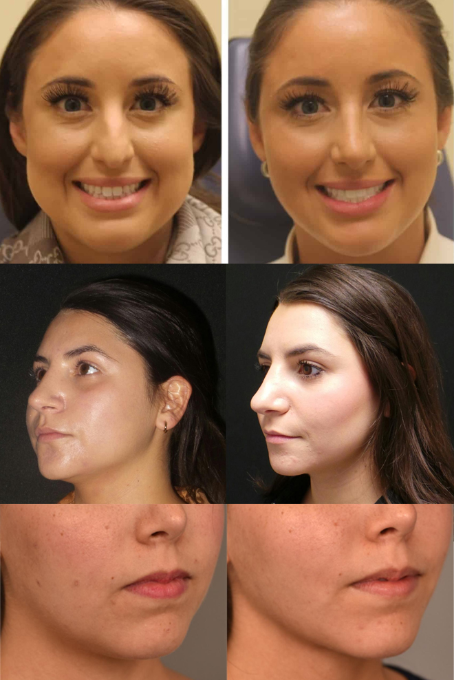 Buccal-Fat-Removal-Treatments-Cozmetika-Clinic