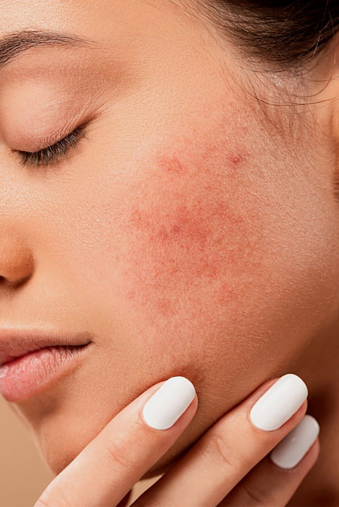 Burn-Reconstruction-Treatment-at-Cozmetika-Clinics