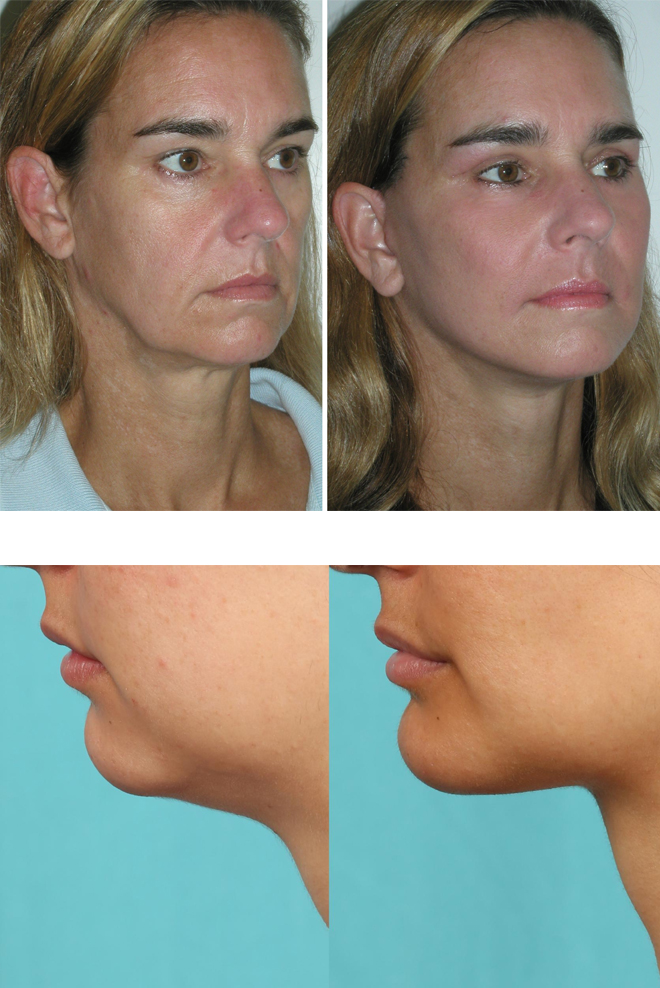 Cheek Implants-Treatment-Cozmetika-Clinic
