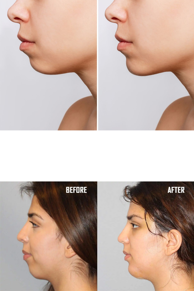 Chin-Augmentation-Treatment-Cozmetika-Clinic