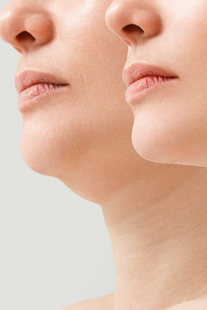 Double-Chin-Reduction-Treatment-at-Cozmetika-Clinic