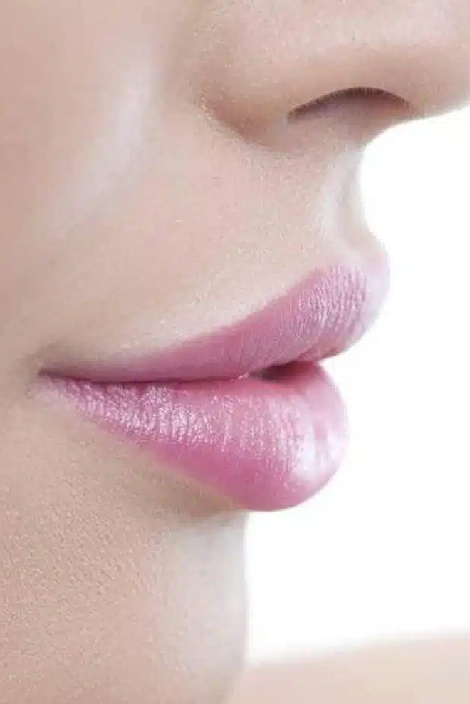 Lip-Reduction-Treatment-at-Cozmetika-Clinic