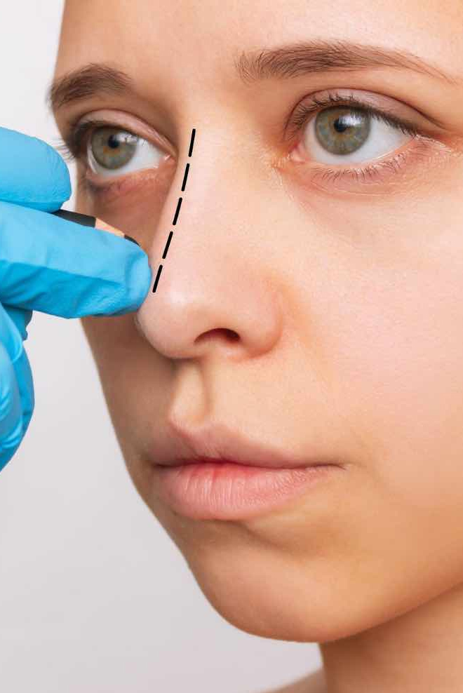 Nose-Tip-Plasty-Treatment-at-Cozmetika-Clinic