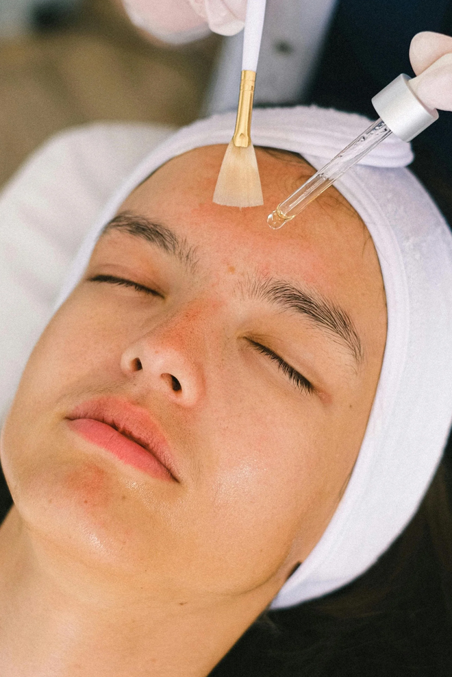 Chemical-Peel-Treatment-in-Islamabad