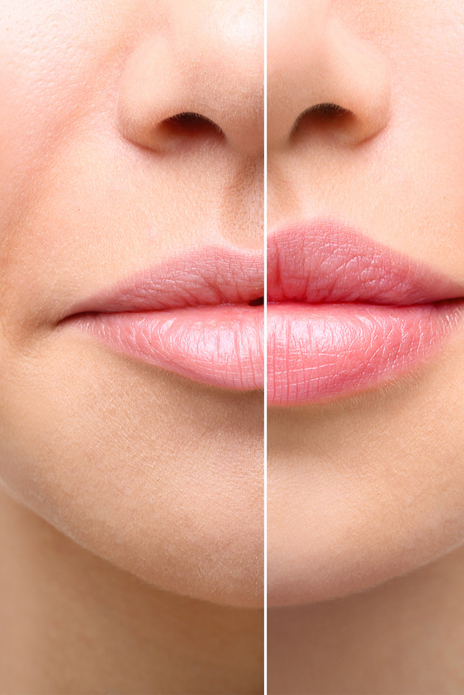 Lip-Augmentation-Treatment-Cozmetika-Clinic