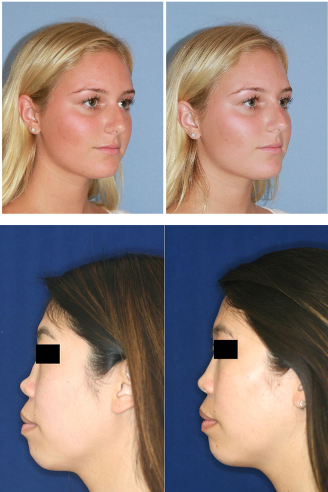 Non-surgical-nose-job-Treatment-Cozmetika-Clinic