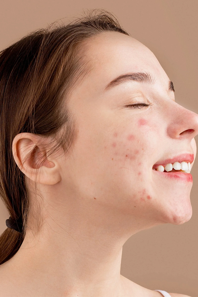 Skin-Acne-Treatment-in-Islamabad