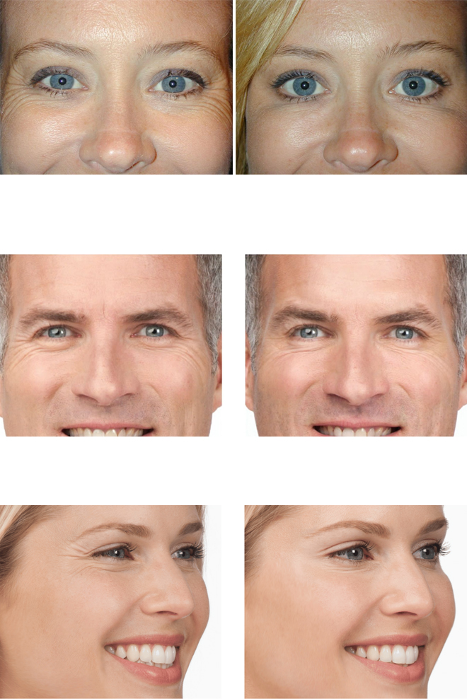 botox-for-crows-feet-Treatment-Cozmetika-Clinic