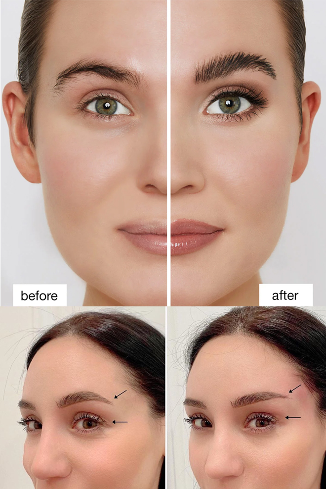 eye-brow-lift-Treatment-Cozmetika-Clinics