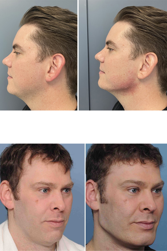 jawline-augmentation-Treatment-Cozmetika-Clinic