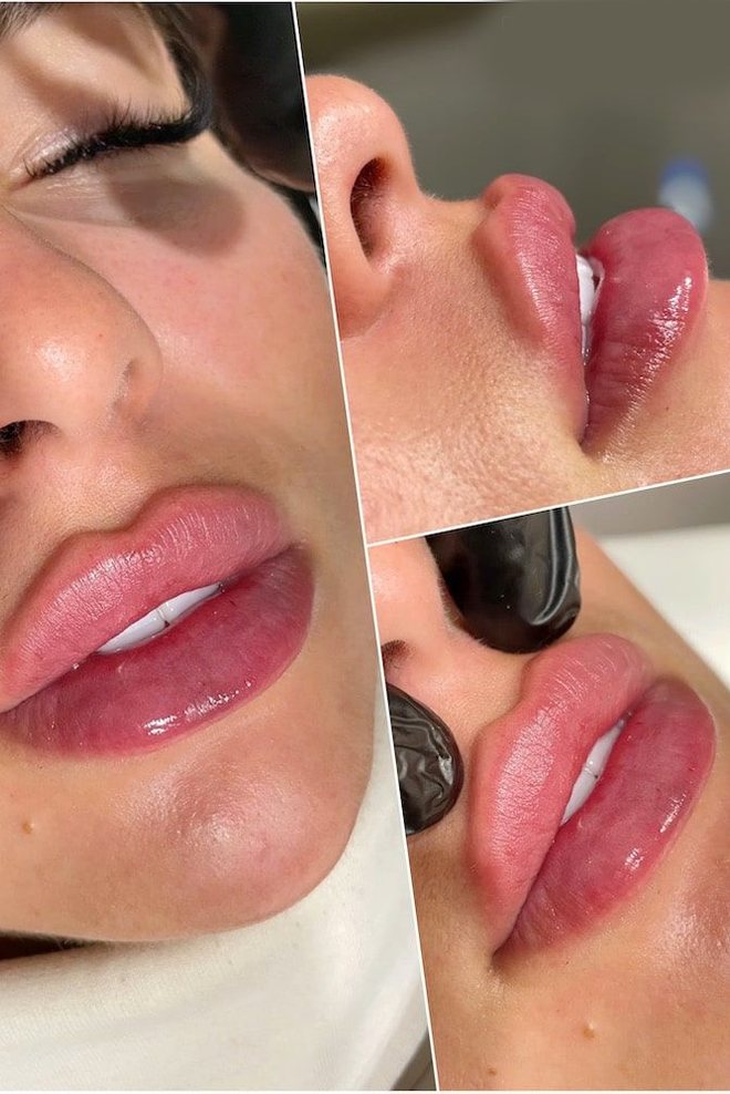 russian-lip-filler-Treatment-Cozmetika-Clinic