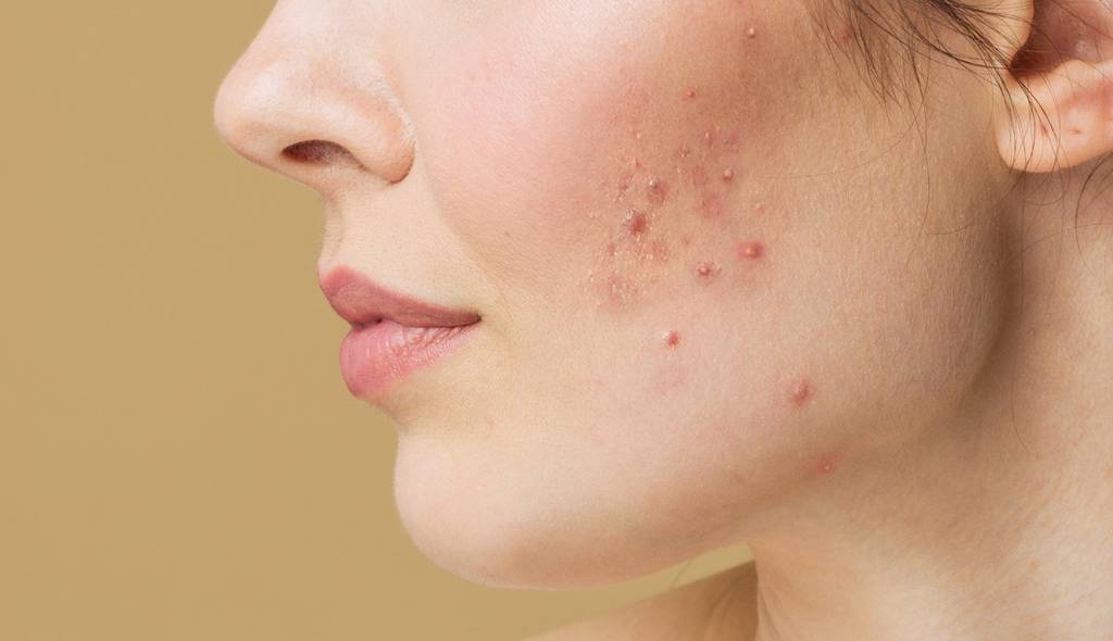 Hydra Facial for Acne Prone Skin in Islamabad